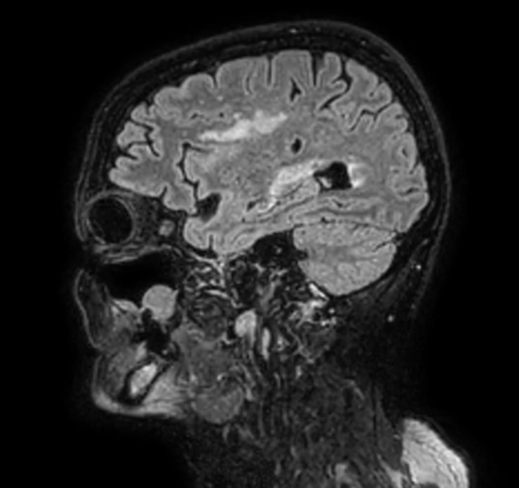Sagittal 3D VIEW - T2w FLAIR