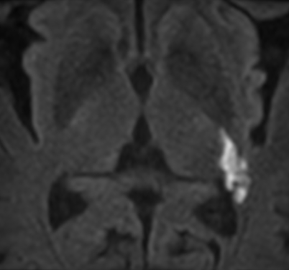 Zoom Diffusion (b1000)