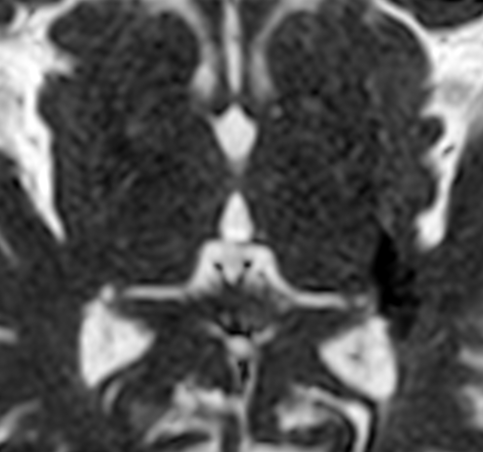 Zoom Diffusion (ADC)