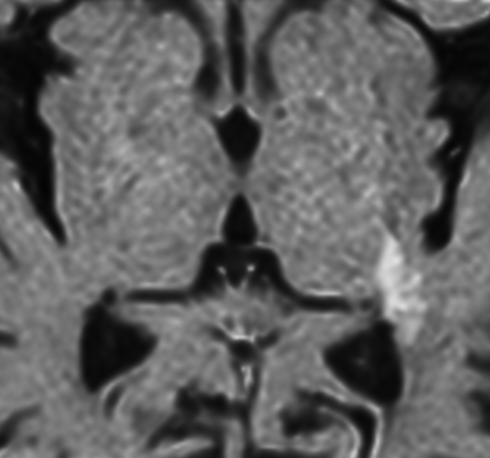 Zoom Diffusion (eADC)