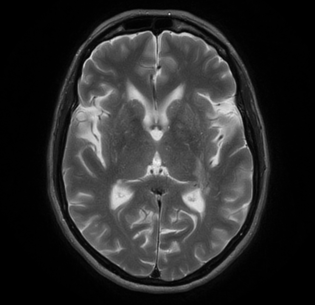 MultiVane XD - T2w TSE