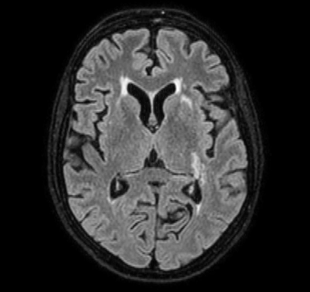 3D VIEW - T2w FLAIR (axial reformat)