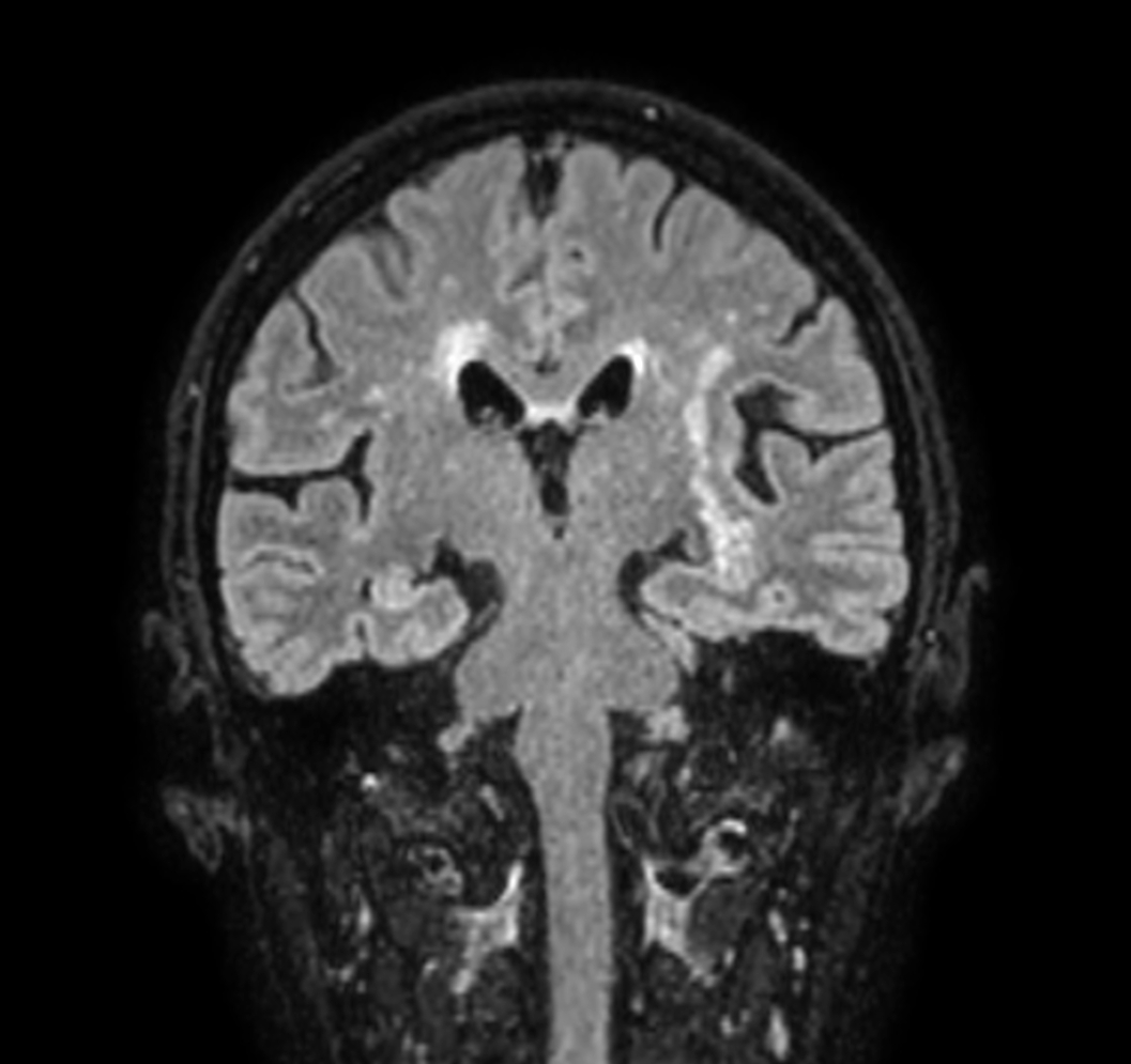 3D VIEW - T2w FLAIR (coronal reformat)
