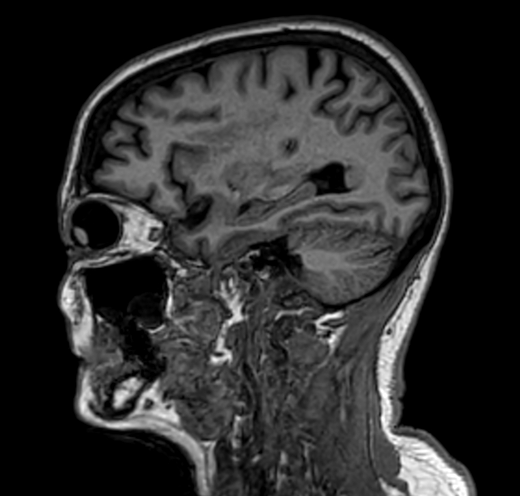 Sagittal 3D VIEW - T1w TFE