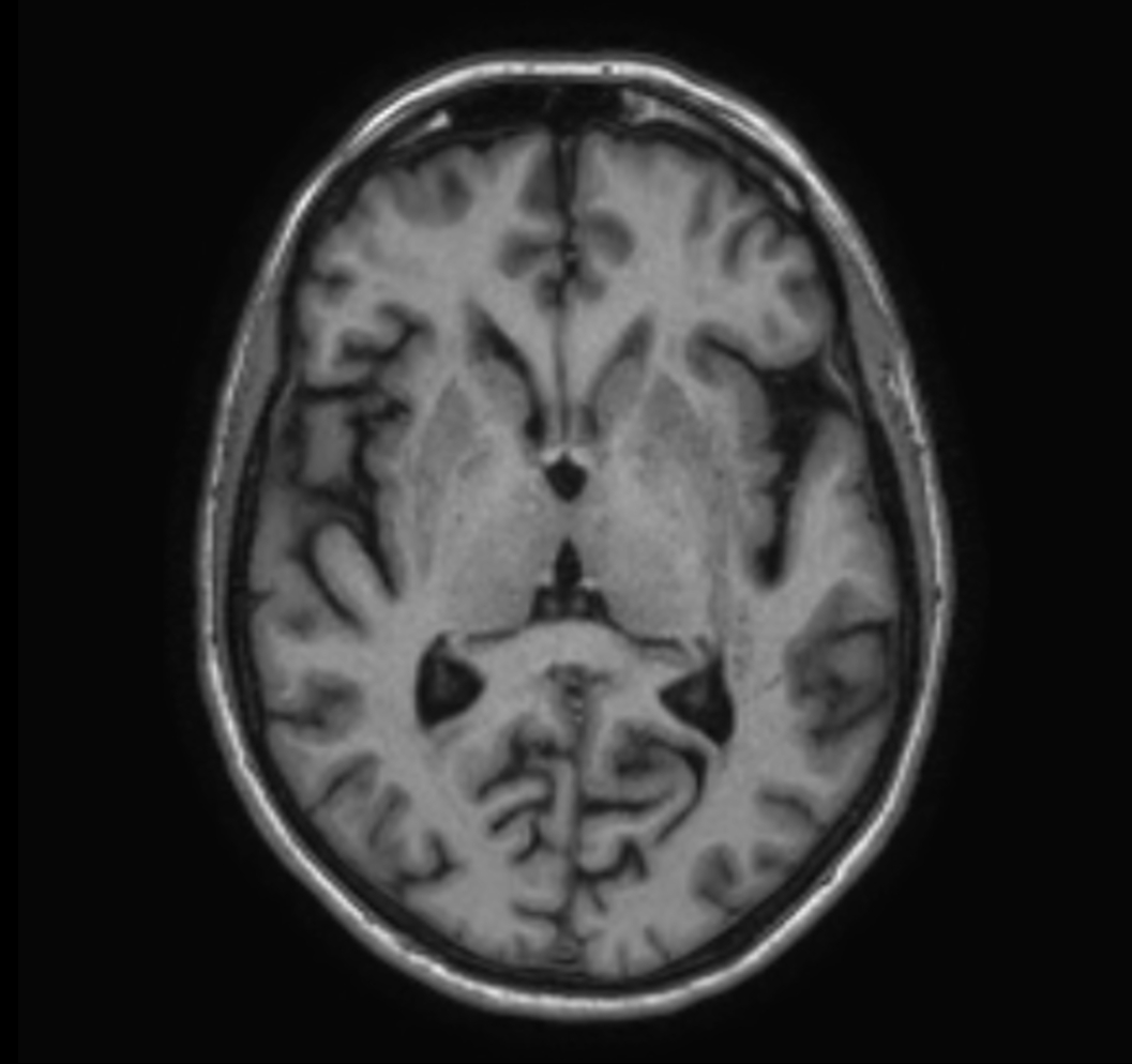 3D VIEW - T1w TFE (axial reformat)