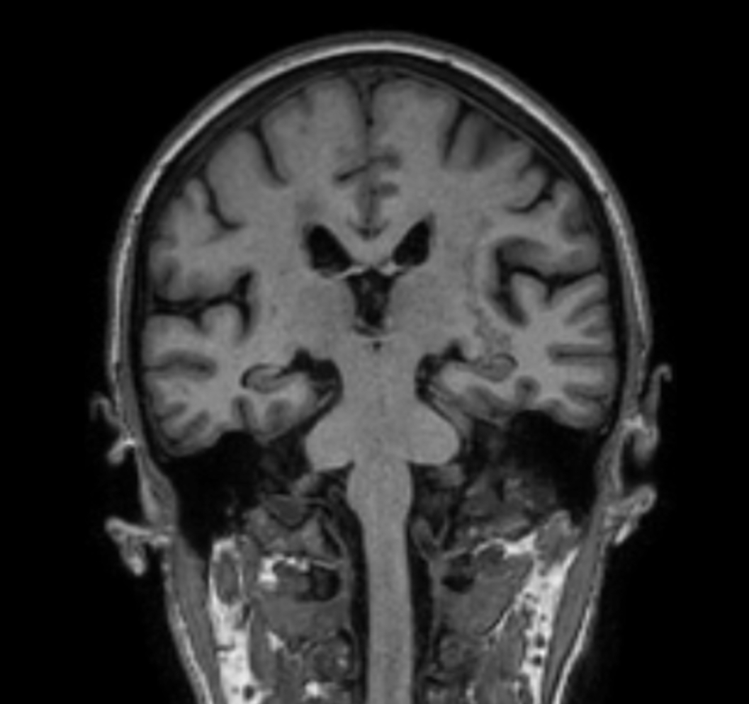 3D VIEW - T1w TFE (coronal reformat)