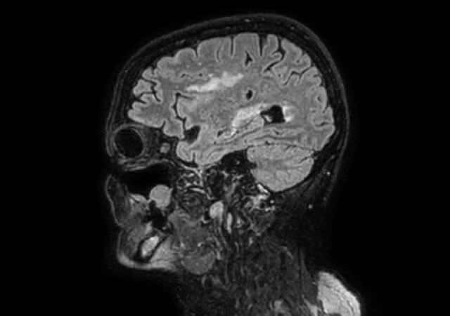 Sagittal 3D VIEW - T2w FLAIR