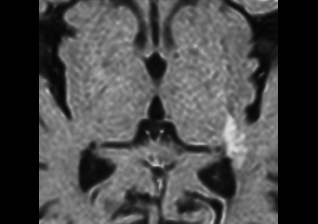 Zoom Diffusion (eADC)