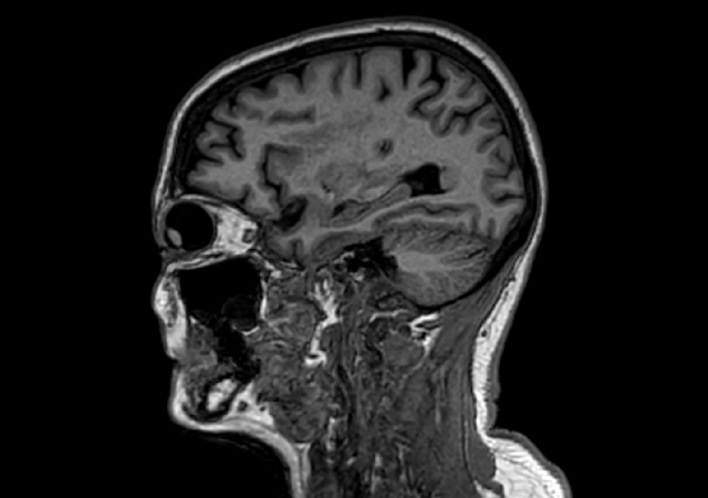 Sagittal 3D VIEW - T1w TFE