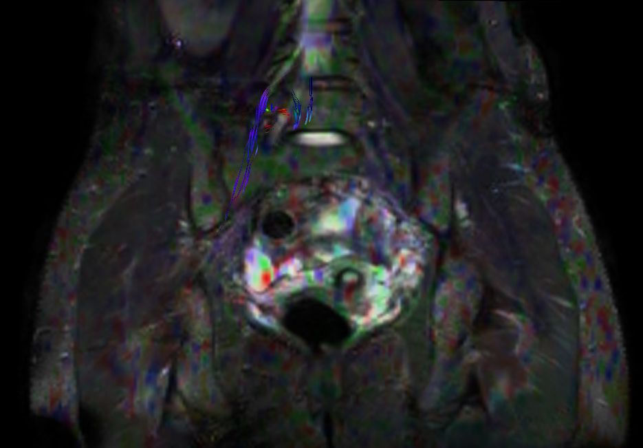 DTI (underlay = 3D NerveVIEW)