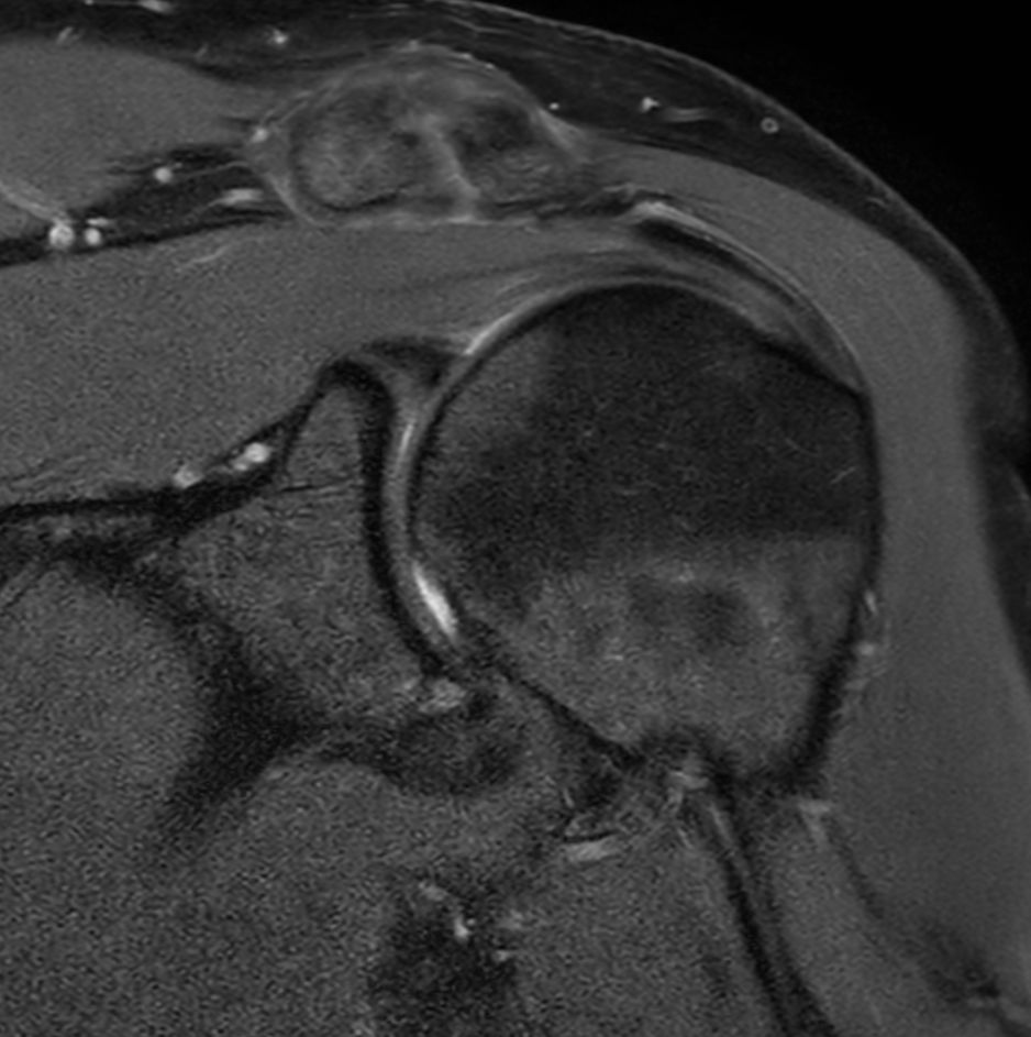 Coronal mDIXON XD - PDw TSE (water only)