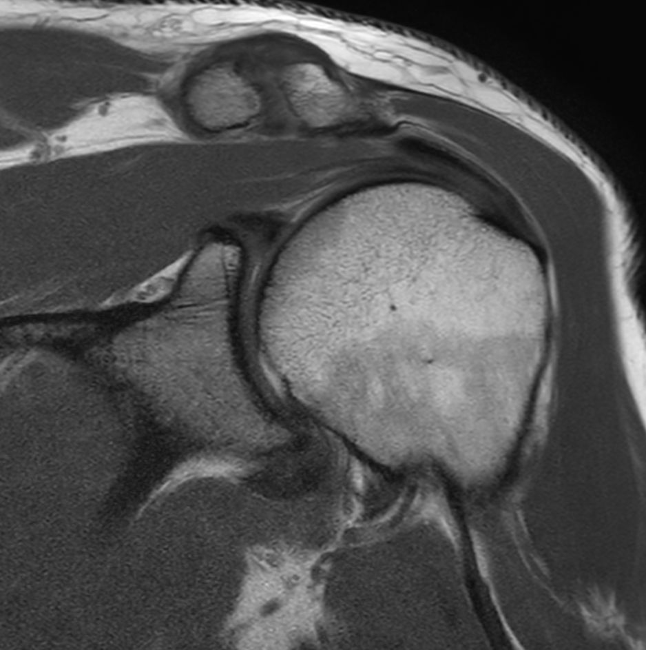 Coronal mDIXON XD - PDw TSE (in phase)