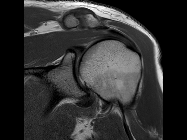 Coronal PDw TSE