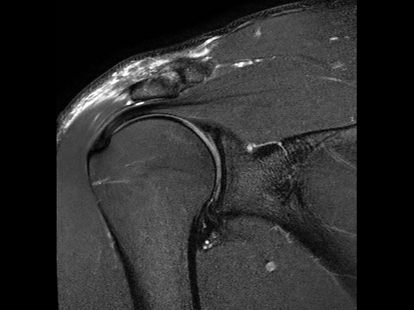 Coronal T2w SPAIR