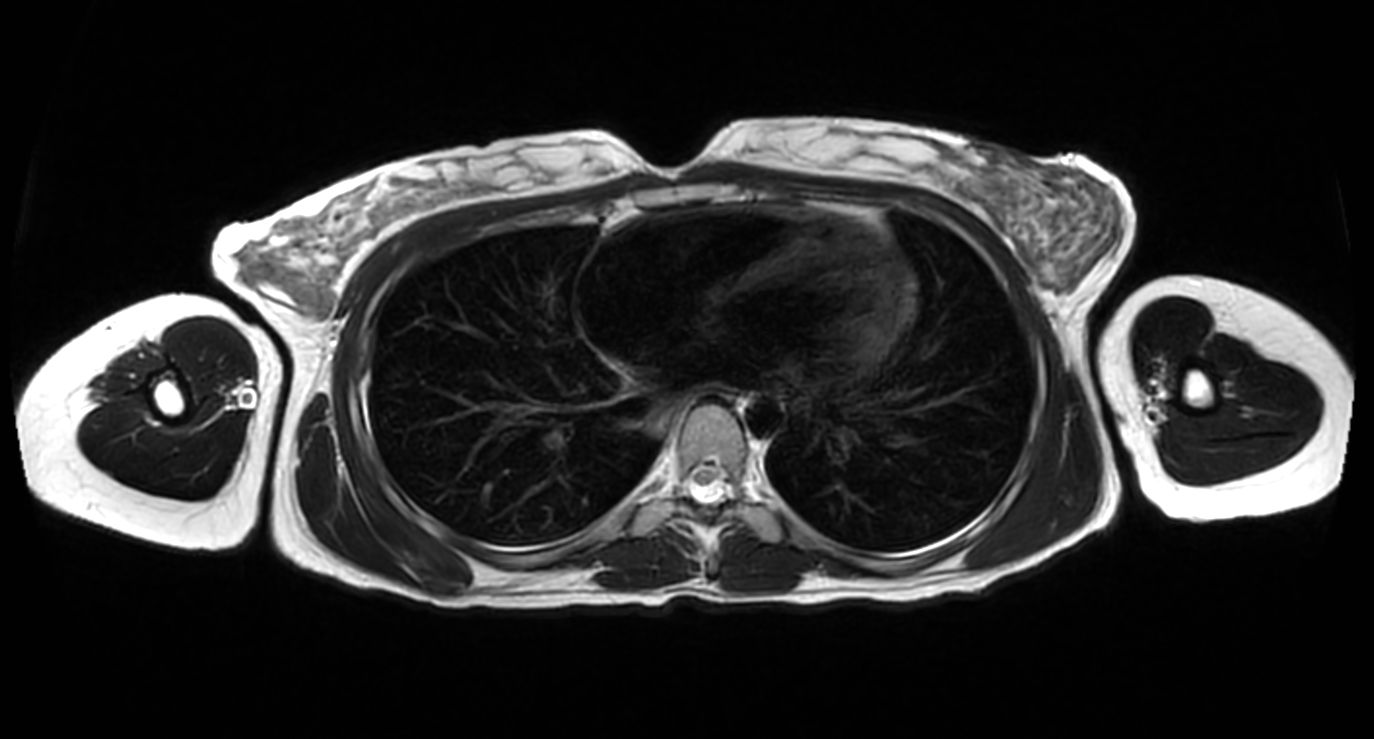 T2w TSE - MultiVane XD