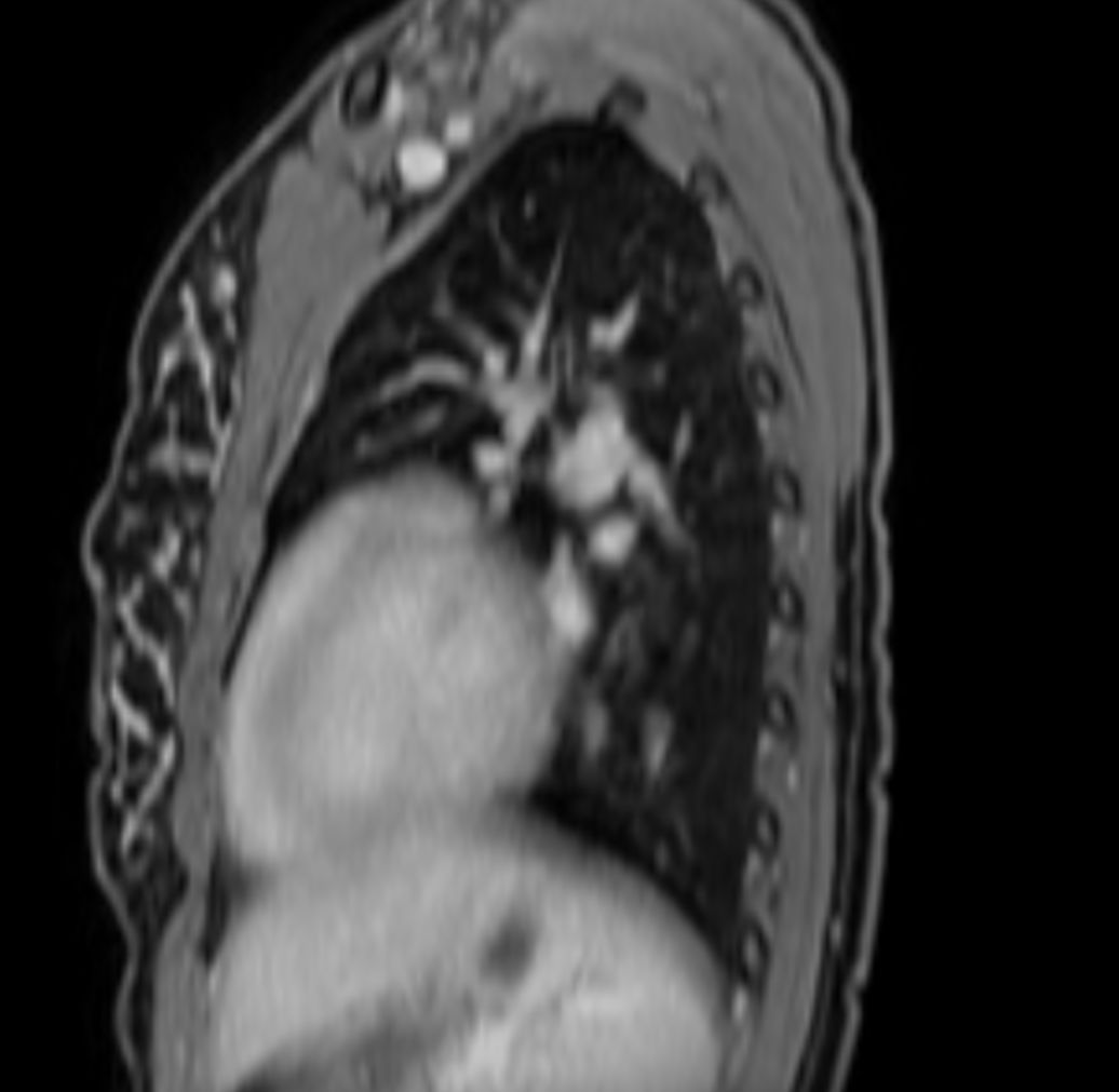 T1w mDIXON XD with gado (Water only) (MPR)