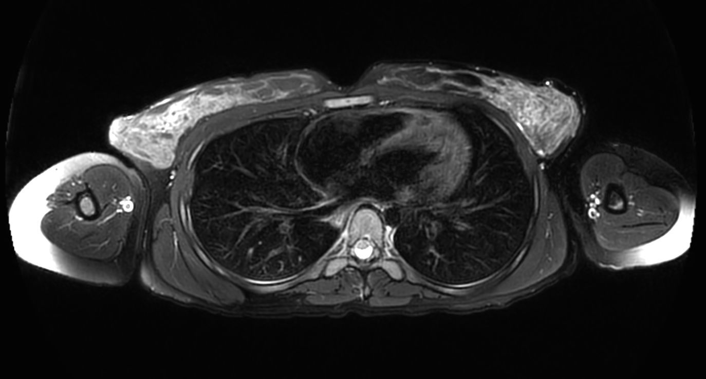 T2w SPIR - MultiVane XD