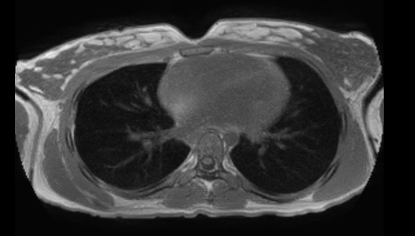 T1w mDIXON XD (In Phase)