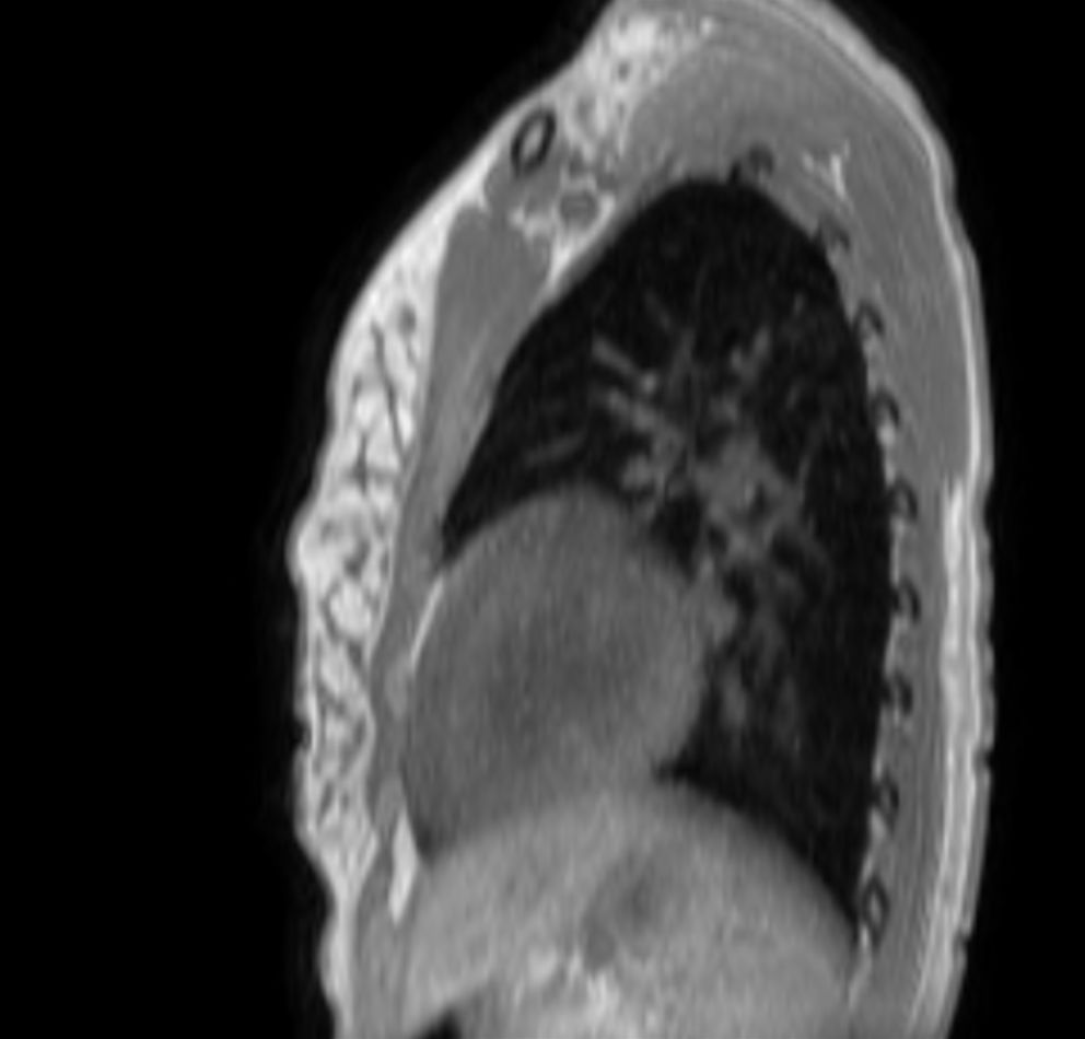 T1w mDIXON XD (In Phase) (MPR)