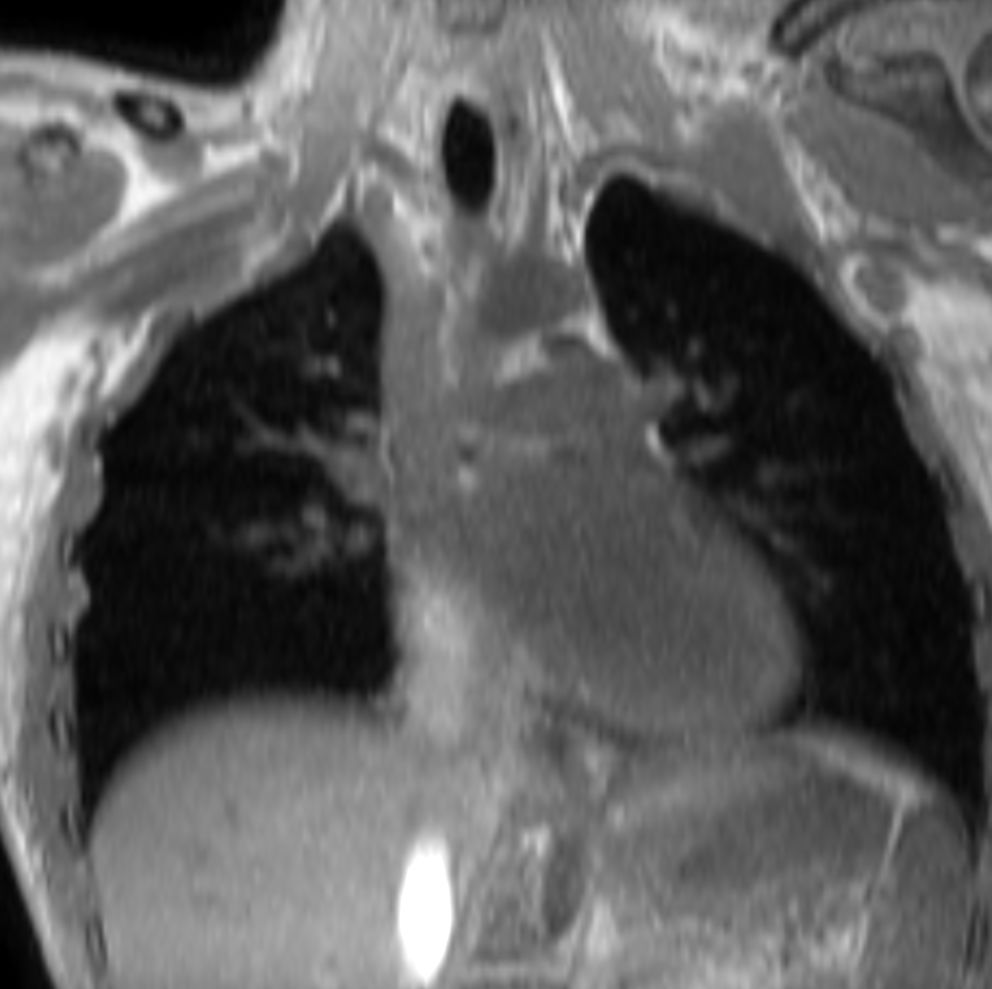 T1w mDIXON XD (In Phase) (MPR)