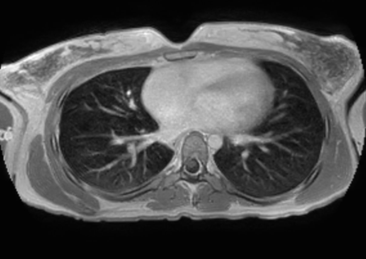 T1w mDIXON XD with gado (In Phase)
