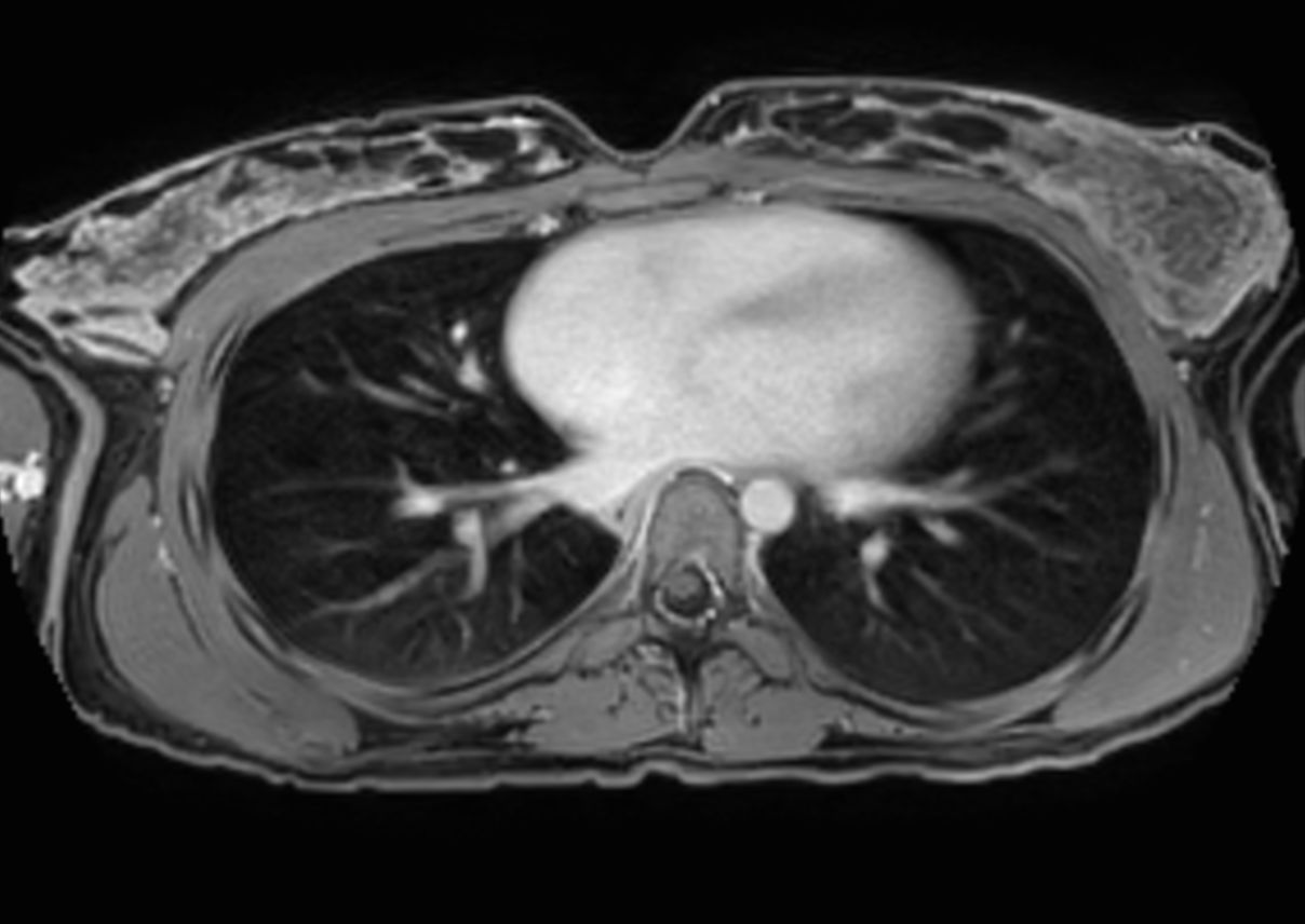 T1w mDIXON XD with gado (Water only)