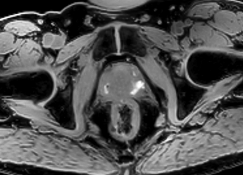 Axial 3D T1w mDIXON FFE (water only)