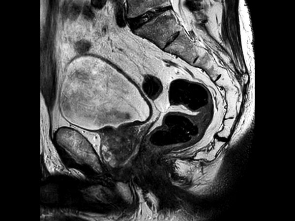 Sagittal T2w TSE