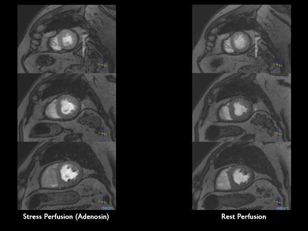 Rest Perfusion