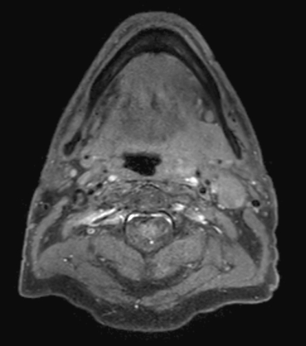T1w TSE mDIXON (water only) pre contrast 