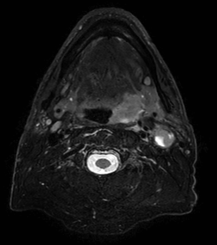 T2w TSE mDIXON (water only)