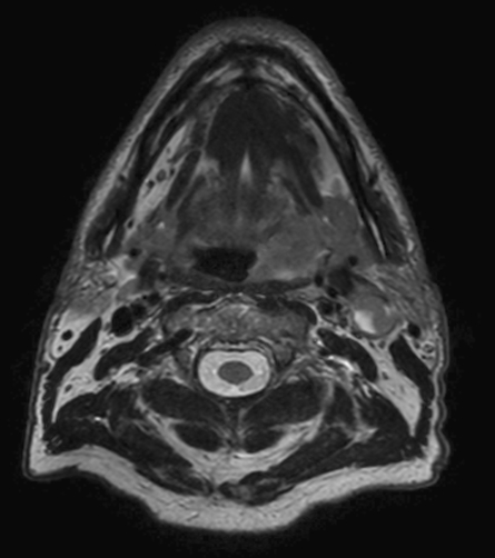 T2w TSE mDIXON (in-phase)