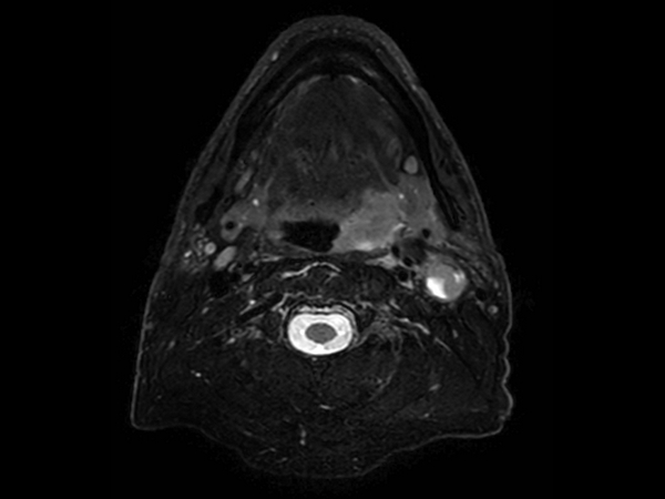 T2w TSE mDIXON (water only)