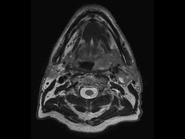 T2w TSE mDIXON (in-phase)