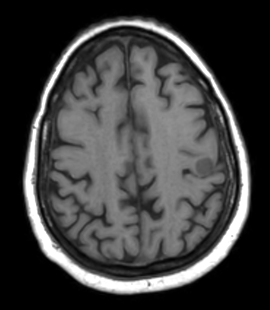 Axial 3D T1w FFE pre contrast