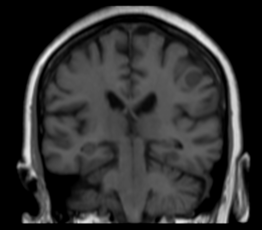 3D T1w FFE (coronal reformat) pre contrast