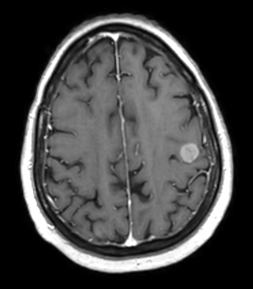 Axial 3D T1w FFE post contrast