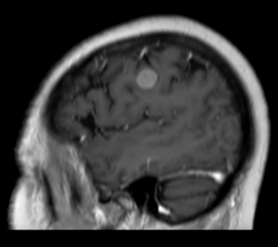 3D T1w FFE (sagittal reformat) post contrast