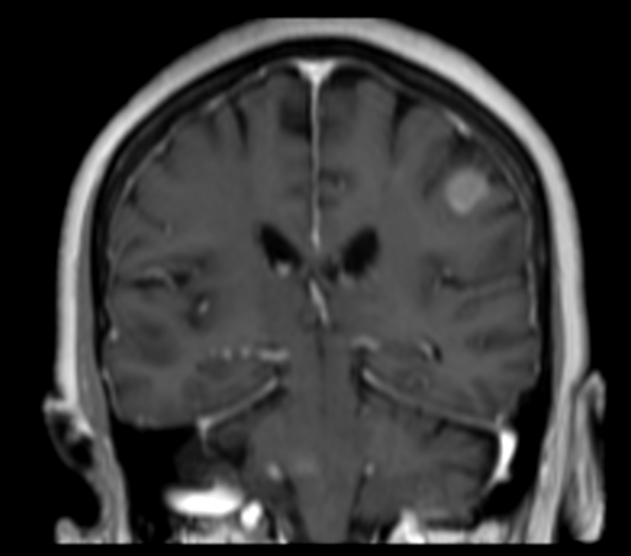 3D T1w FFE (coronal reformat) post contrast