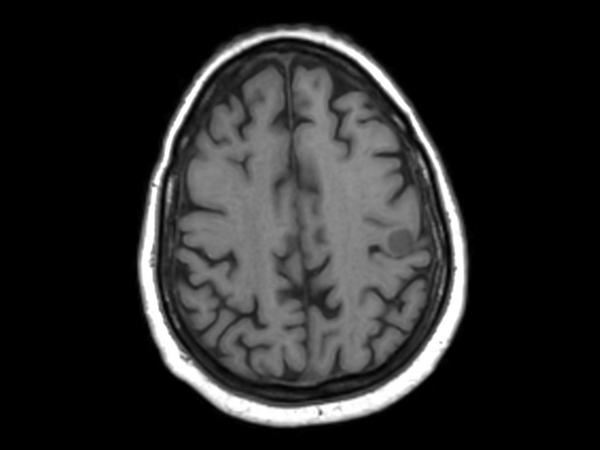 Axial 3D T1w FFE pre contrast