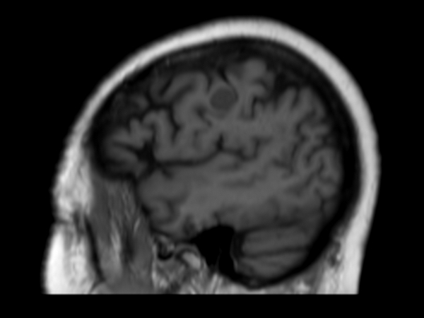 3D T1w FFE (sagittal reformat) pre contrast