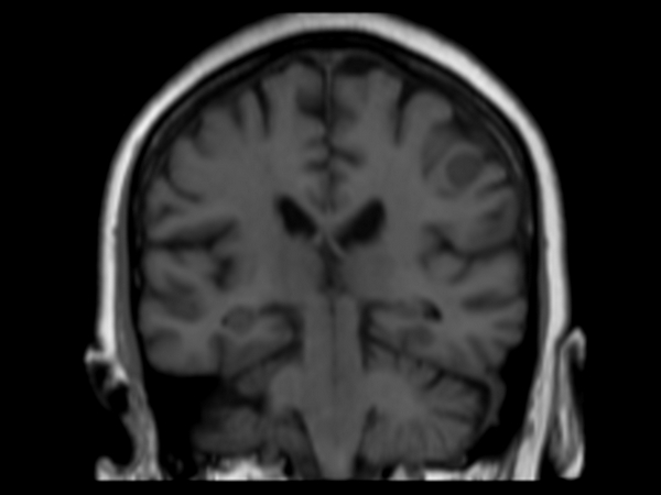 3D T1w FFE (coronal reformat) pre contrast