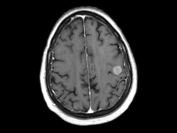 Axial 3D T1w FFE post contrast