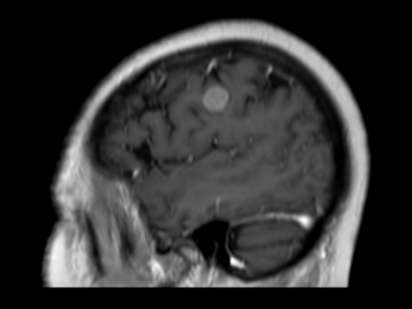 3D T1w FFE (sagittal reformat) post contrast