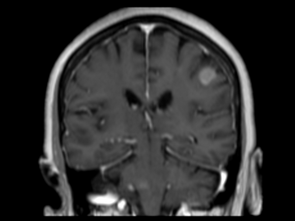 3D T1w FFE (coronal reformat) post contrast