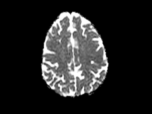 Axial DWI  (ADC)