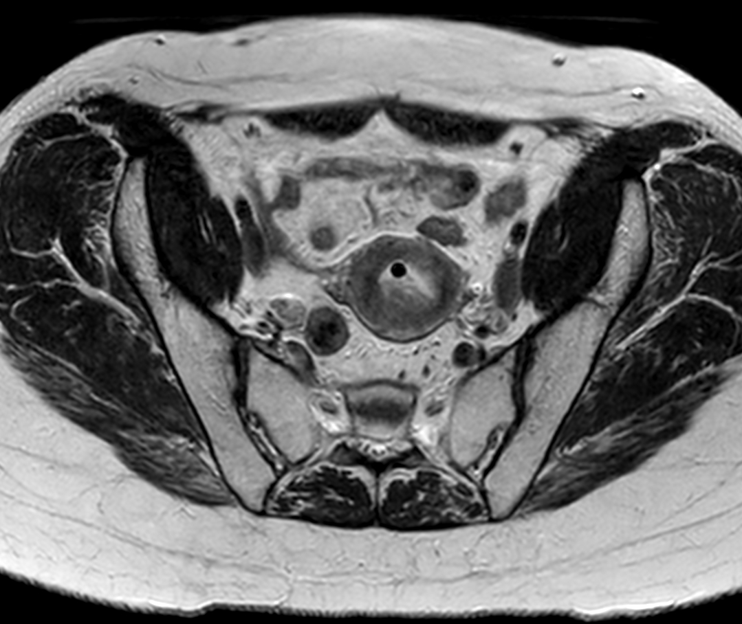 Axial oblique 2D T2w TSE