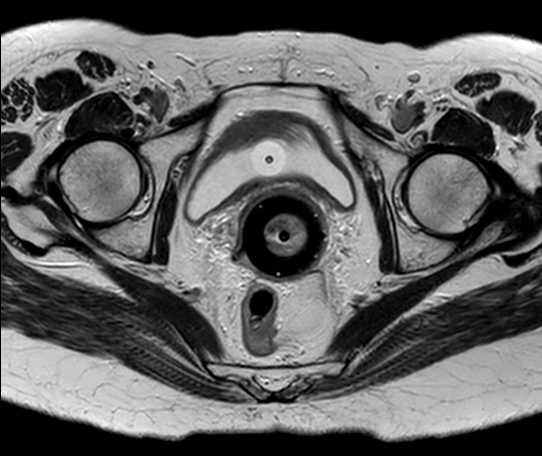 Axial oblique 2D T2w TSE