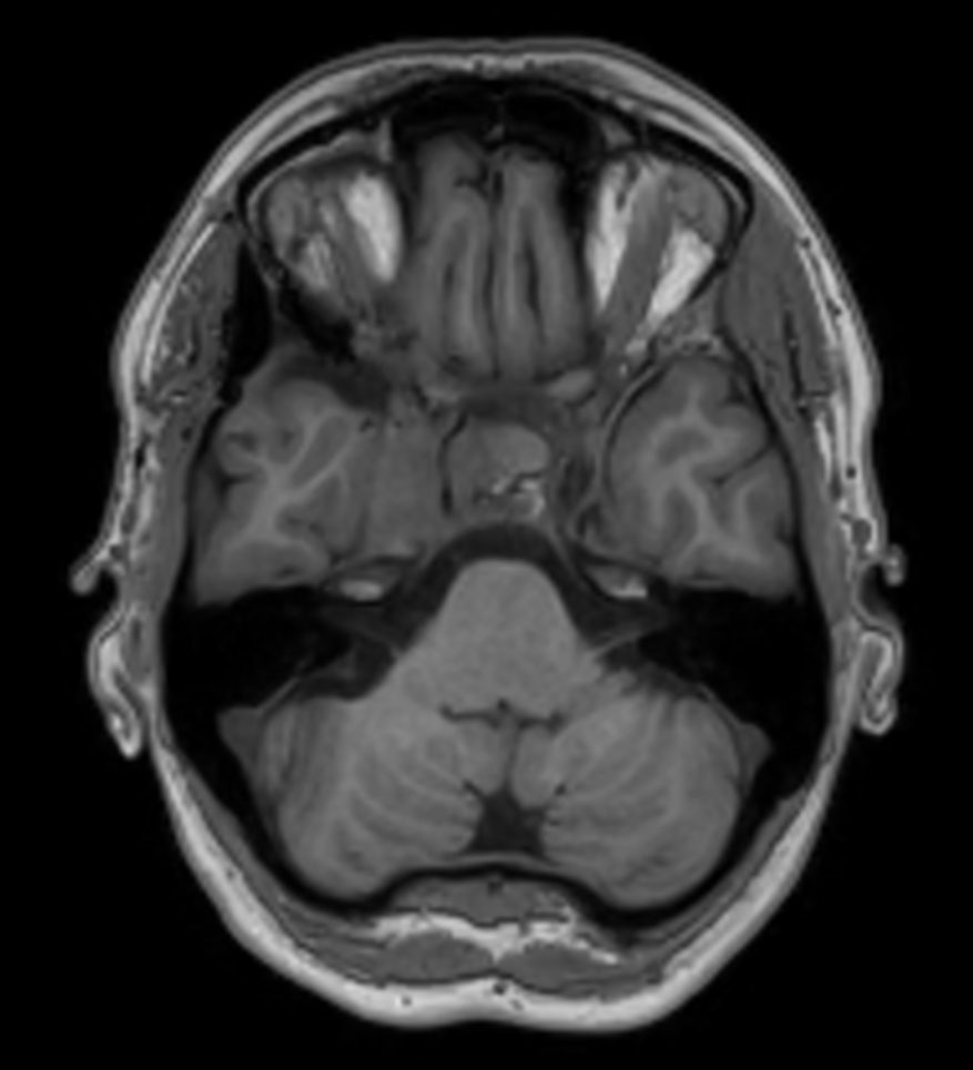 Axial 3D T1w TFE pre contrast