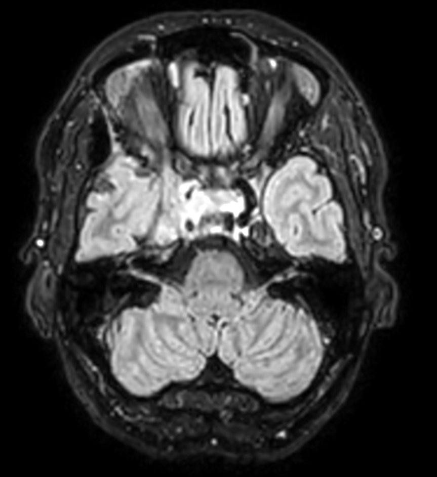 Axial 3D T2w TSE FLAIR